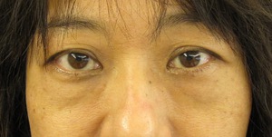 目の下のたるみ、目のくまでお悩みの方、切らずに完璧に解決します。TCB-R法　手術直後　症例写真